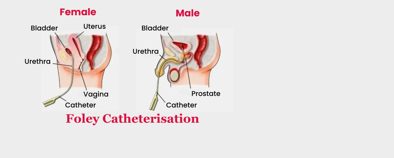 Foley Catheterisation