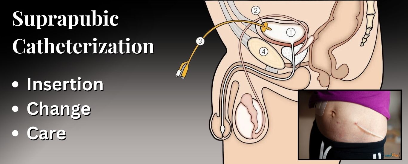 Suprapubic Catheterization Service At Home