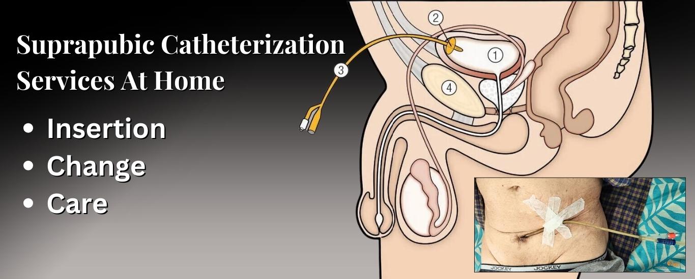 Suprapubic Catheterization Service At Home