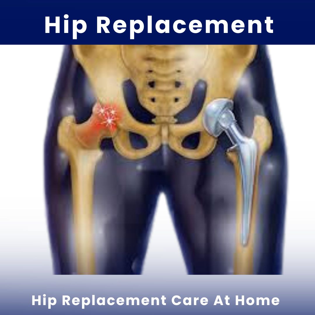 Hip Replacement Care At Home