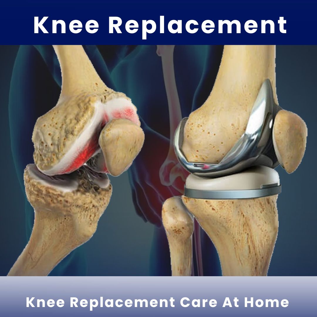 Knee Replacement Care At Home