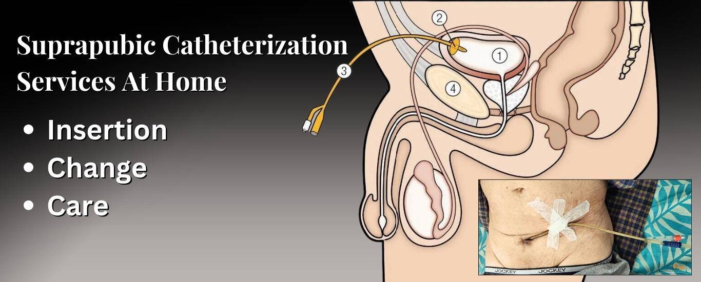 Suprapubic Catheterization Service At Home