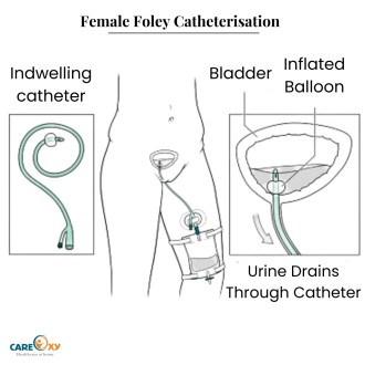 Female Foley Catheterisation