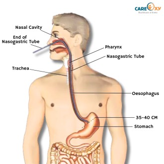 Nasogastric Tube Insertion