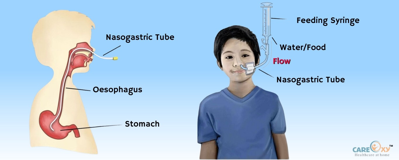 Nasogastric Tube