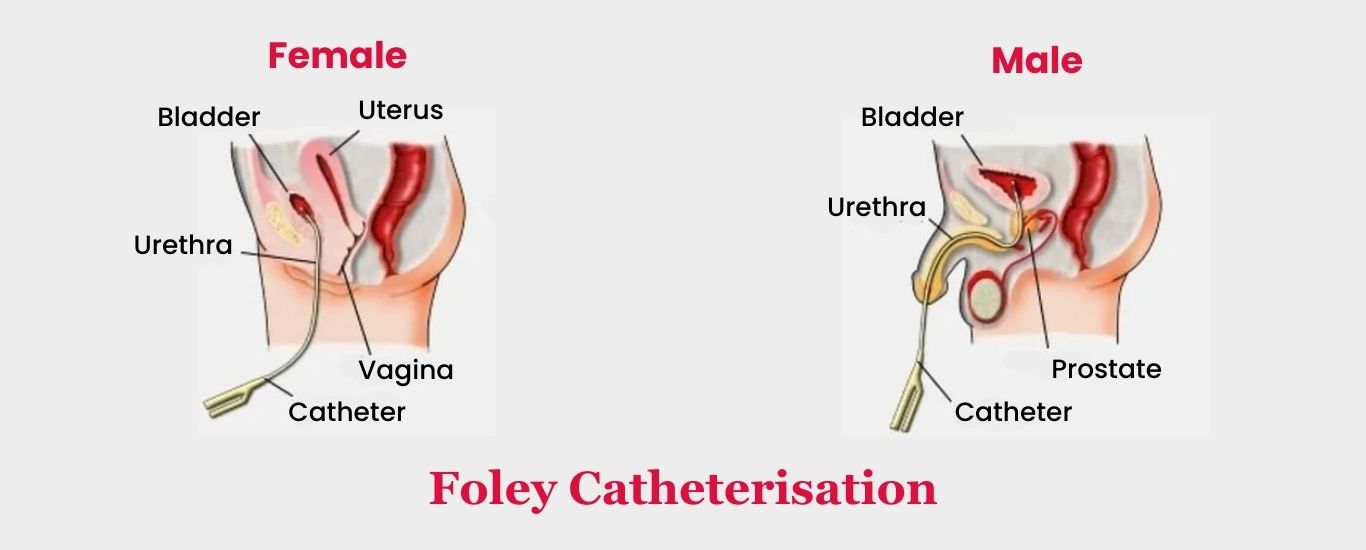 Foley Catheterisation